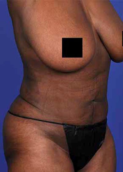 Liposuction and Smartlipo Before & After Gallery - Patient 5883273 - Image 2