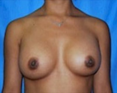 Breast Augmentation Before & After Gallery - Patient 5946056 - Image 2