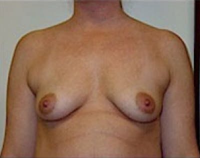 Breast Augmentation Before & After Gallery - Patient 5946059 - Image 1
