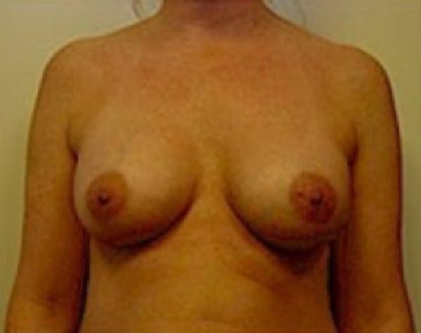 Breast Augmentation Before & After Gallery - Patient 5946059 - Image 2