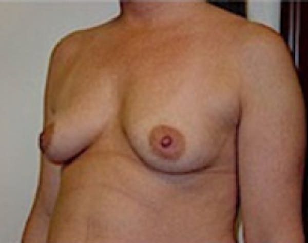 Breast Augmentation Before & After Gallery - Patient 5946059 - Image 3