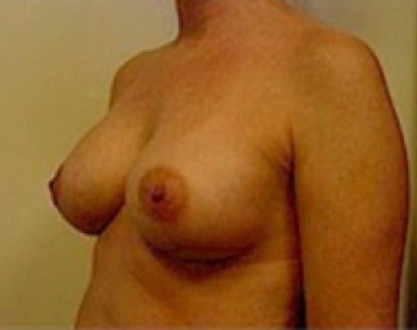 Breast Augmentation Before & After Gallery - Patient 5946059 - Image 4