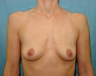 Breast Augmentation Before & After Gallery - Patient 5946062 - Image 1