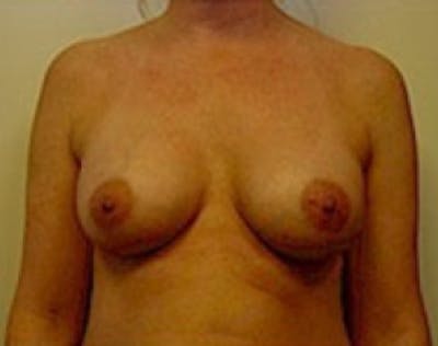Breast Augmentation Before & After Gallery - Patient 5946062 - Image 2