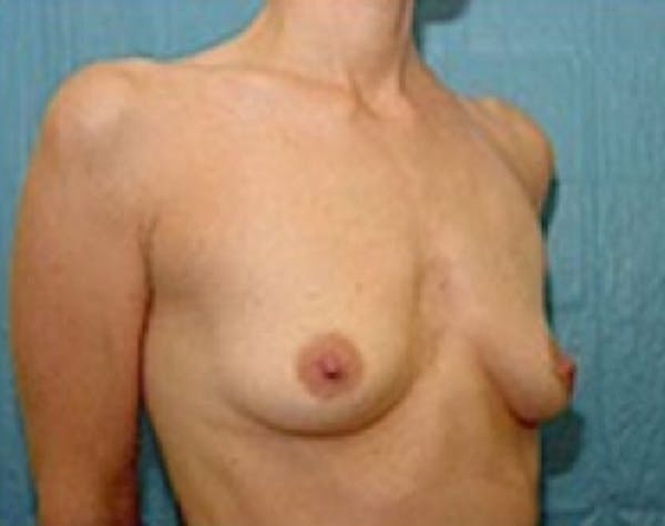 Breast Augmentation Before & After Gallery - Patient 5946062 - Image 3