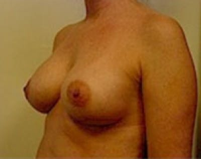 Breast Augmentation Before & After Gallery - Patient 5946062 - Image 4