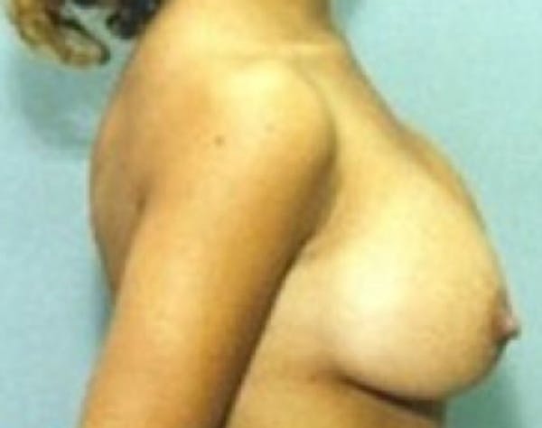 Breast Augmentation Gallery - Patient 5946070 - Image 2