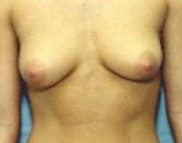 Breast Augmentation Before & After Gallery - Patient 5946074 - Image 1