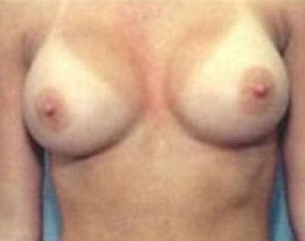 Breast Augmentation Before & After Gallery - Patient 5946074 - Image 2