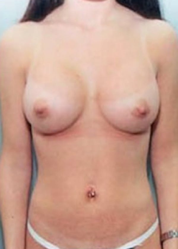 Breast Augmentation Before & After Gallery - Patient 5946079 - Image 2