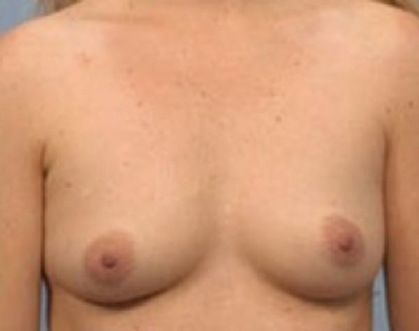 Breast Augmentation Before & After Gallery - Patient 5946083 - Image 1