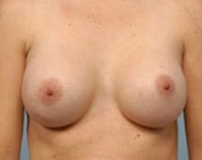 Breast Augmentation Before & After Gallery - Patient 5946083 - Image 2