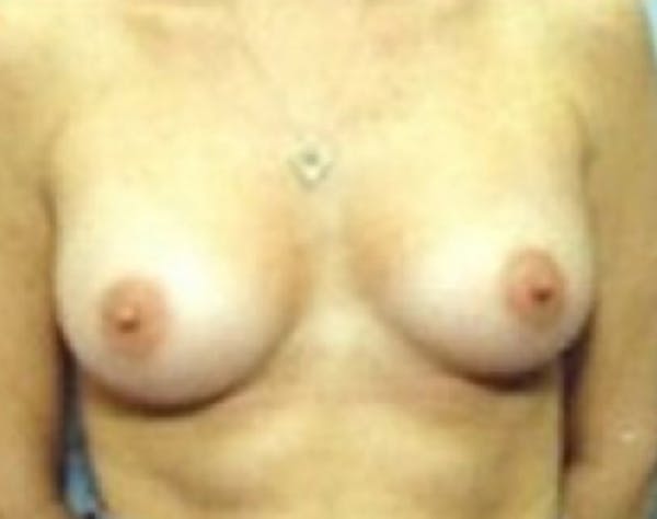 Breast Augmentation Before & After Gallery - Patient 5946086 - Image 2