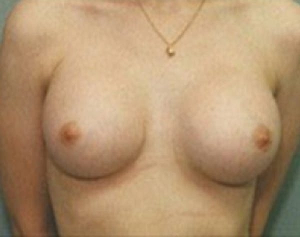 Breast Augmentation Before & After Gallery - Patient 5946087 - Image 2