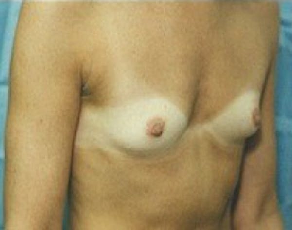 Breast Augmentation Gallery - Patient 5946254 - Image 1