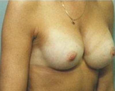 Breast Augmentation Before & After Gallery - Patient 5946254 - Image 2