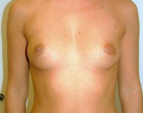 Before and After Breast Augmentation in Manhattan 2