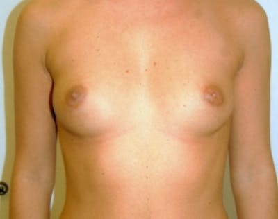 Breast Augmentation Before & After Gallery - Patient 5946285 - Image 1