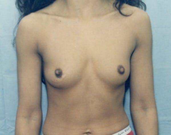 Breast Augmentation Before & After Gallery - Patient 5946286 - Image 1