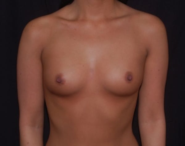 Breast Augmentation Before & After Gallery - Patient 5946291 - Image 1