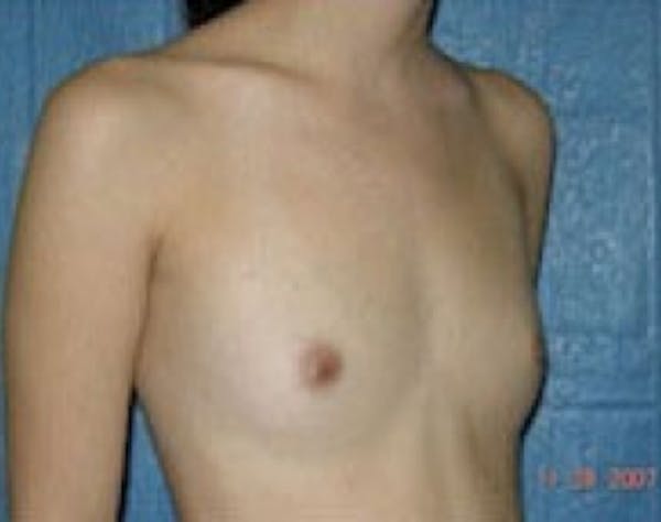 Breast Augmentation Before & After Gallery - Patient 5946301 - Image 1