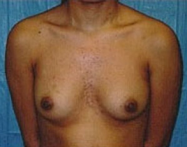 Breast Augmentation Gallery - Patient 5946305 - Image 1