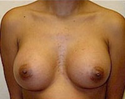 Breast Augmentation Before & After Gallery - Patient 5946305 - Image 2