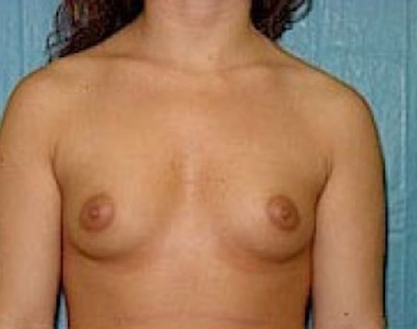 Breast Augmentation Before & After Gallery - Patient 5946309 - Image 1