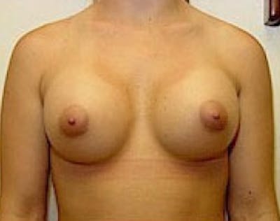 Breast Augmentation Before & After Gallery - Patient 5946309 - Image 2