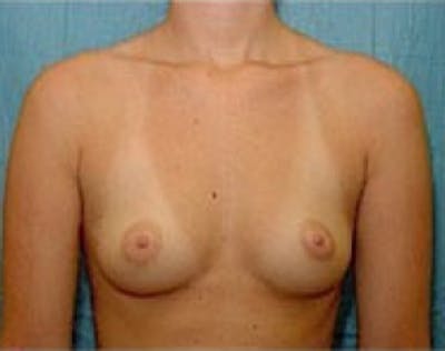 Breast Augmentation Before & After Gallery - Patient 5946317 - Image 1