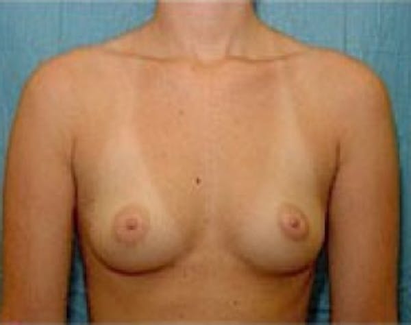 Breast Augmentation Gallery - Patient 5946317 - Image 1