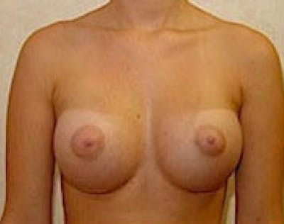Breast Augmentation Before & After Gallery - Patient 5946317 - Image 2