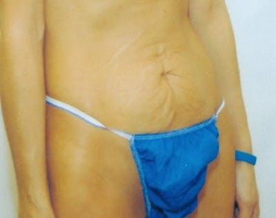 Tummy Tuck Before & After Gallery - Patient 5946319 - Image 1