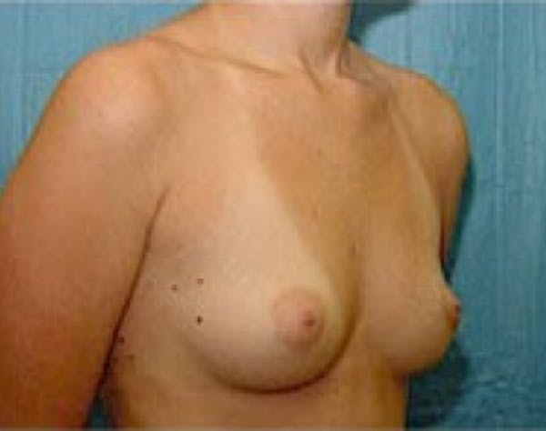 Breast Augmentation Before & After Gallery - Patient 5946317 - Image 3