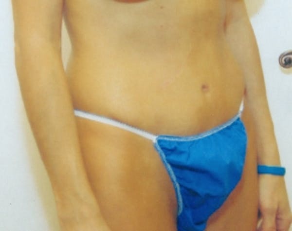 Tummy Tuck Before & After Gallery - Patient 5946319 - Image 2