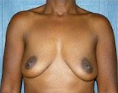 Breast Augmentation Before & After Gallery - Patient 5946333 - Image 1