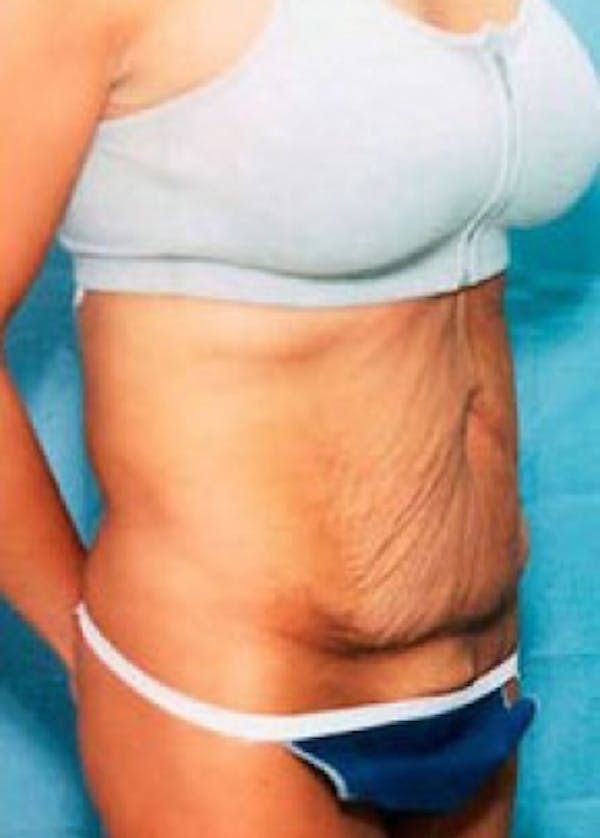 Tummy Tuck Gallery - Patient 5946337 - Image 1