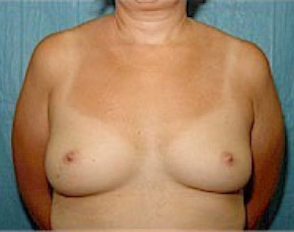 Breast Augmentation Before & After Gallery - Patient 5946343 - Image 1