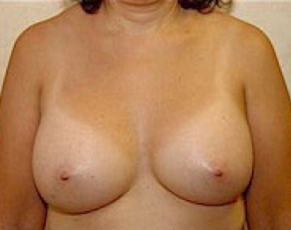 Breast Augmentation Before & After Gallery - Patient 5946343 - Image 2
