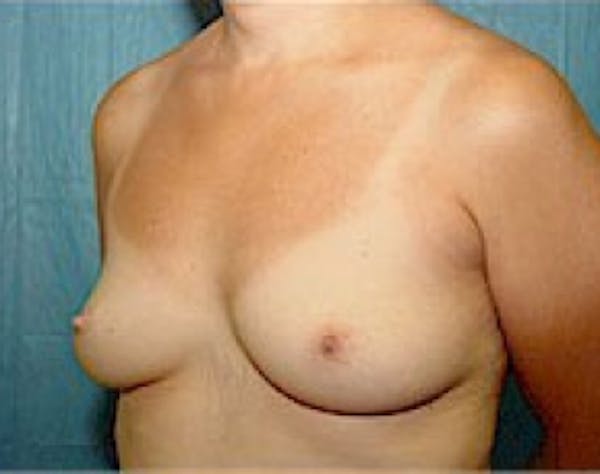 Breast Augmentation Before & After Gallery - Patient 5946343 - Image 3