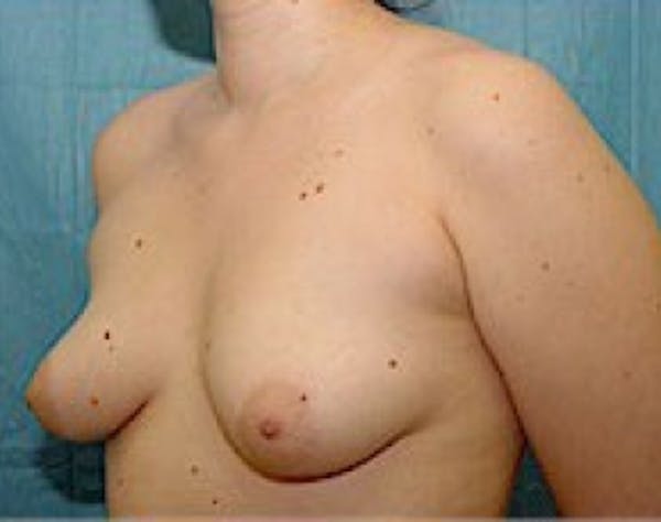 Breast Augmentation Before & After Gallery - Patient 5946354 - Image 1