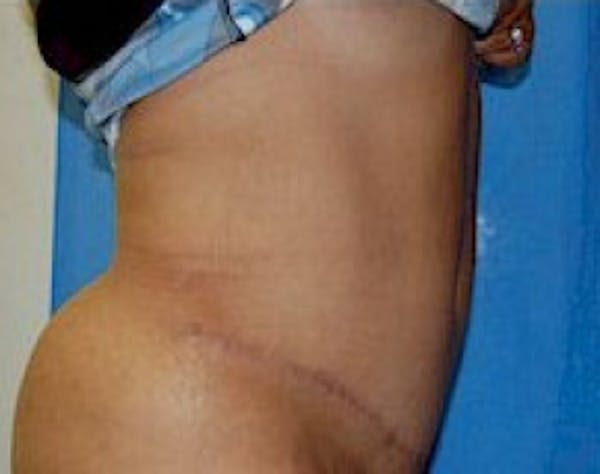 Tummy Tuck Before & After Gallery - Patient 5946347 - Image 4