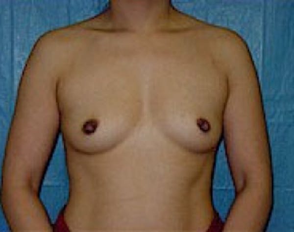 Breast Augmentation Before & After Gallery - Patient 5946453 - Image 1