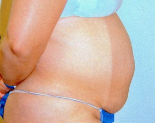 Tummy Tuck Before & After Gallery - Patient 5946412 - Image 1