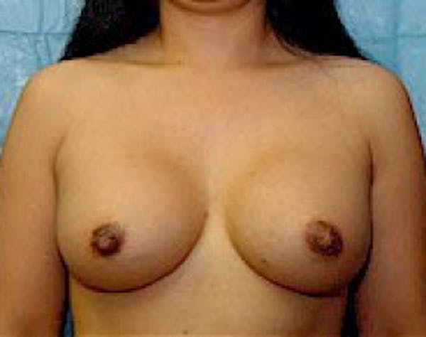 Breast Augmentation Before & After Gallery - Patient 5946453 - Image 2