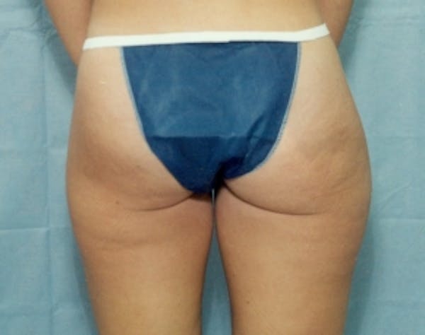 Liposuction and Smartlipo Before & After Gallery - Patient 5946456 - Image 1
