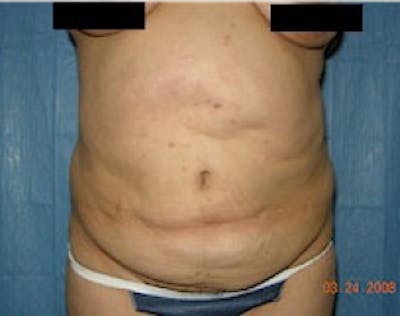 Tummy Tuck Before & After Gallery - Patient 5946468 - Image 1