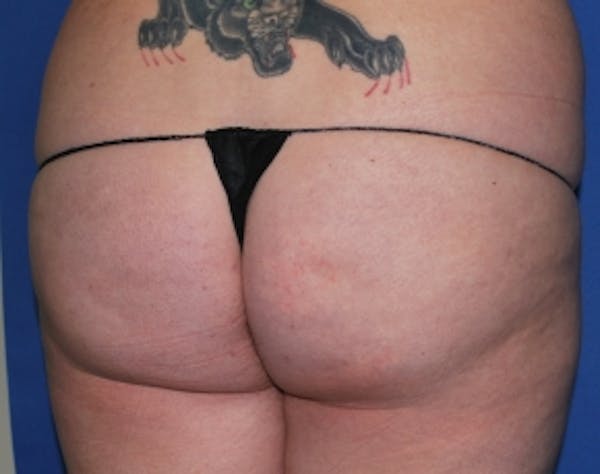 Brazilian Butt Lift Before & After Gallery - Patient 5946463 - Image 7