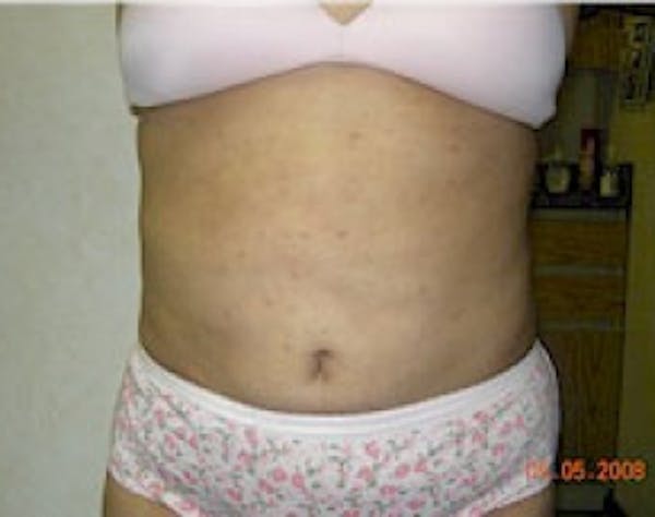Tummy Tuck Gallery - Patient 5946468 - Image 2
