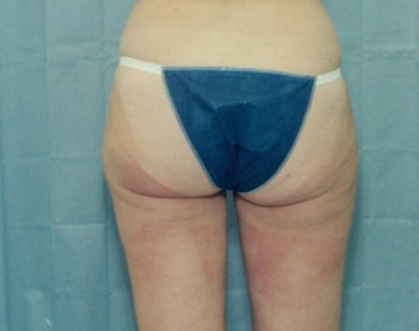 Liposuction and Smartlipo Before & After Gallery - Patient 5946510 - Image 1